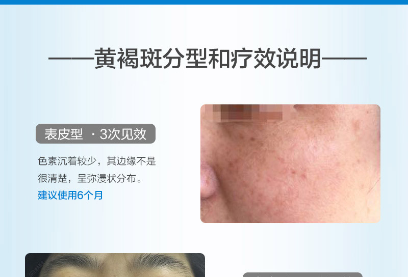 黄褐斑_03.jpg