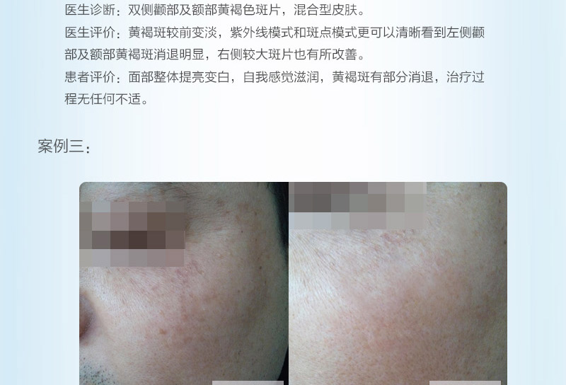 黄褐斑_07.jpg