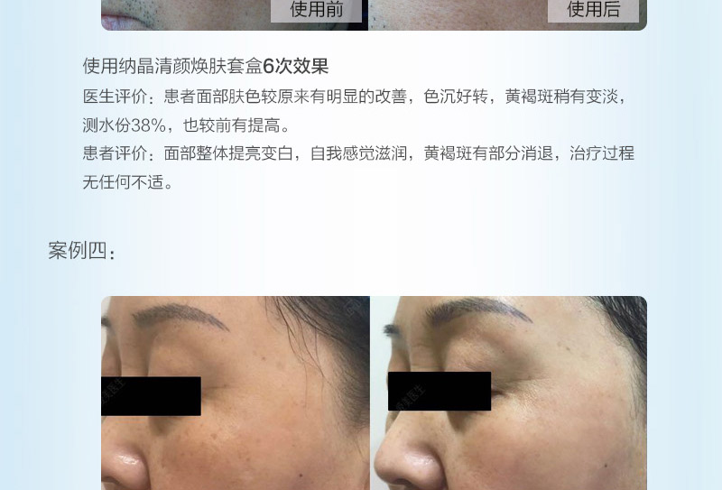 黄褐斑_08.jpg