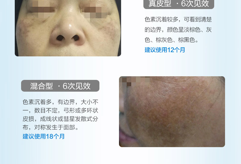 黄褐斑_04.jpg