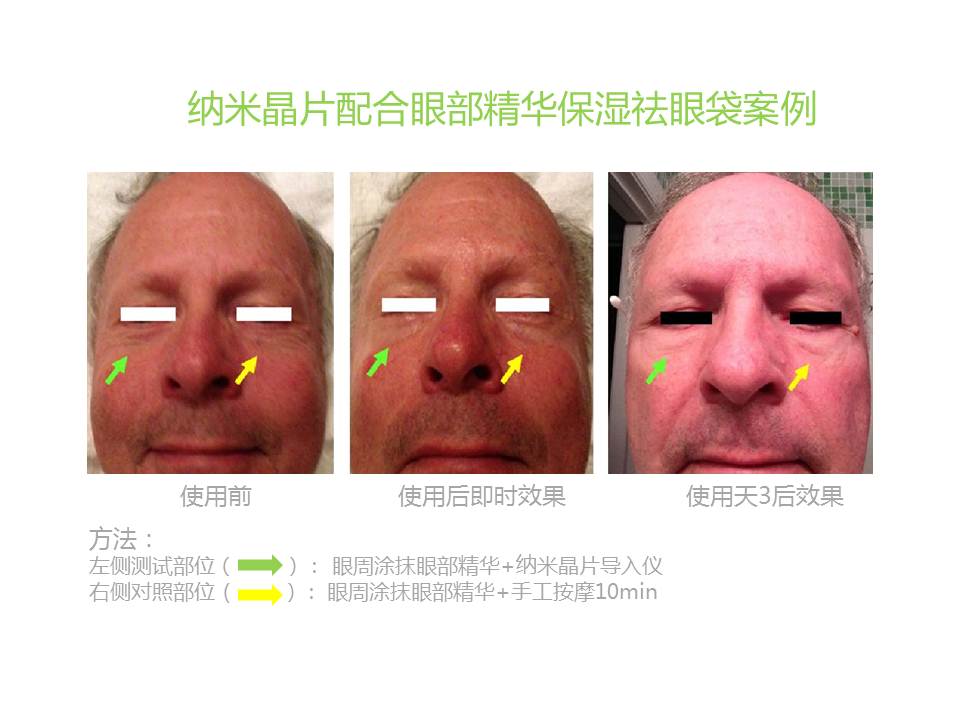 纳晶纳米晶片使用效果案例分享