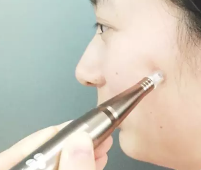 苏州纳通纳米微针导入0.5%氨甲环酸溶液可治疗黄褐斑