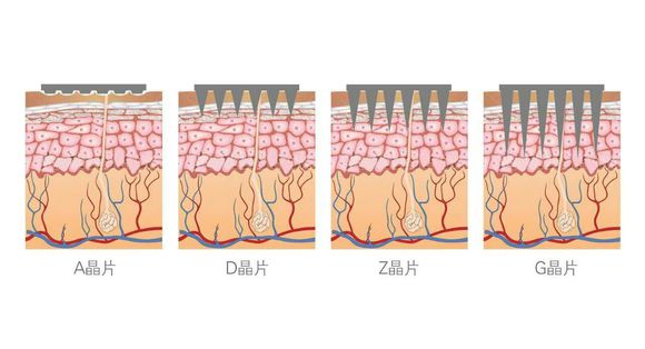 使用苏州纳通纳米微针后出现发红是什么情况？