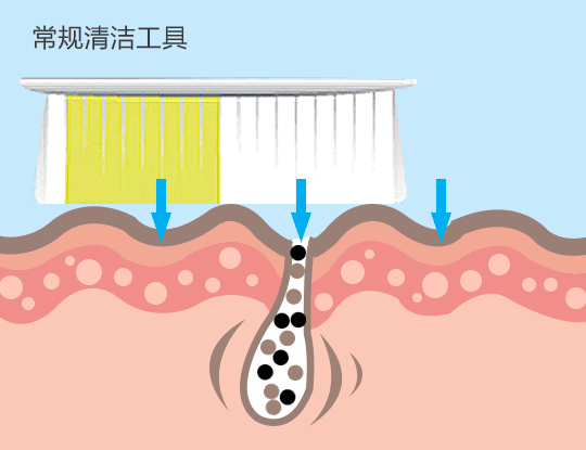 用了苏州纳通微针一段时间后，脸上的痘坑痘印都没了